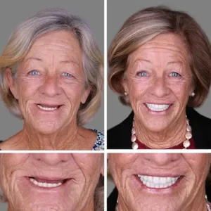 OEOMON™ Medical Full Denture with Strong Suctiond Custom-Fit Full Functional Dentures
